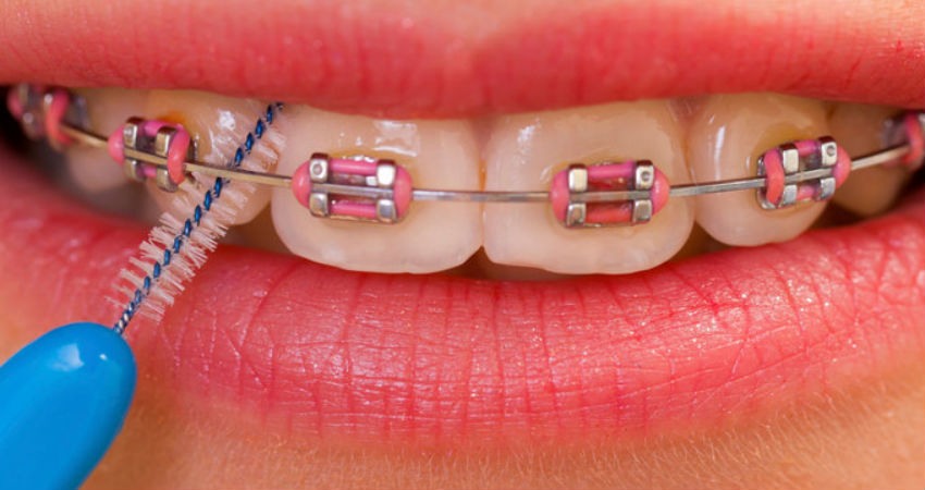 Los brackets como el tratamiento estrella