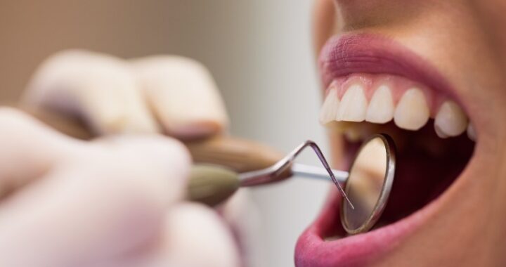 Implantes dentales: todo lo que necesitas saber