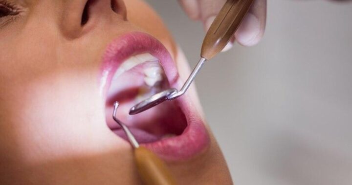 ¿Qué es el sarro en los dientes y por qué es importante eliminarlo?