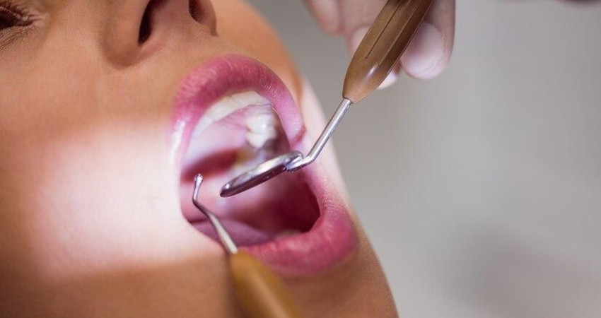 Sarro en los dientes